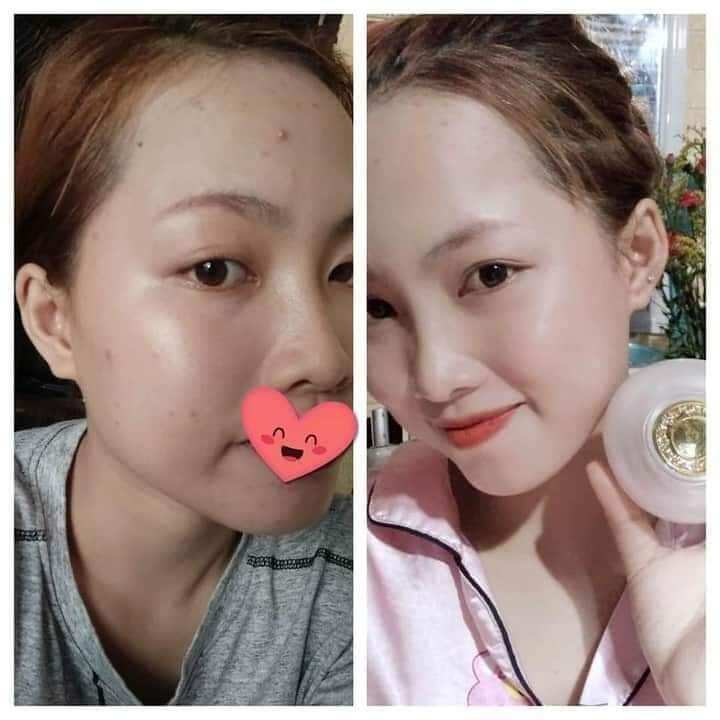COMBO FACE VIP + SERUM COLLAGEN  HUỲNH ĐỔ ( XÓA MỤN +NÁM +TÀN NHAN +ĐỒI MỒI + TRẮNG DA VVV )