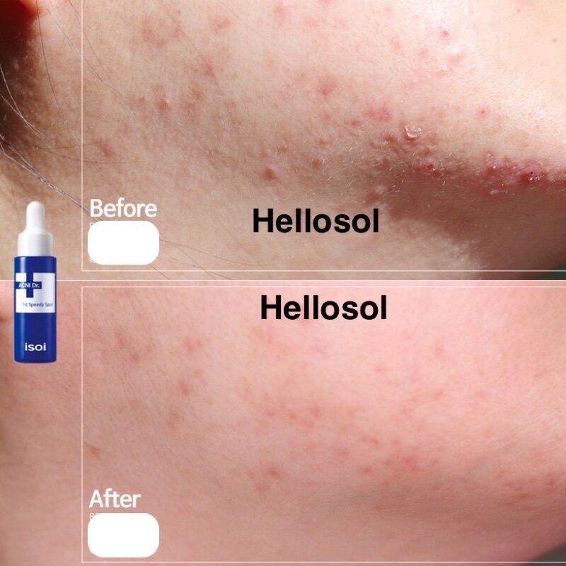 Chấm mụn Isoi Anci Doctor 14ml