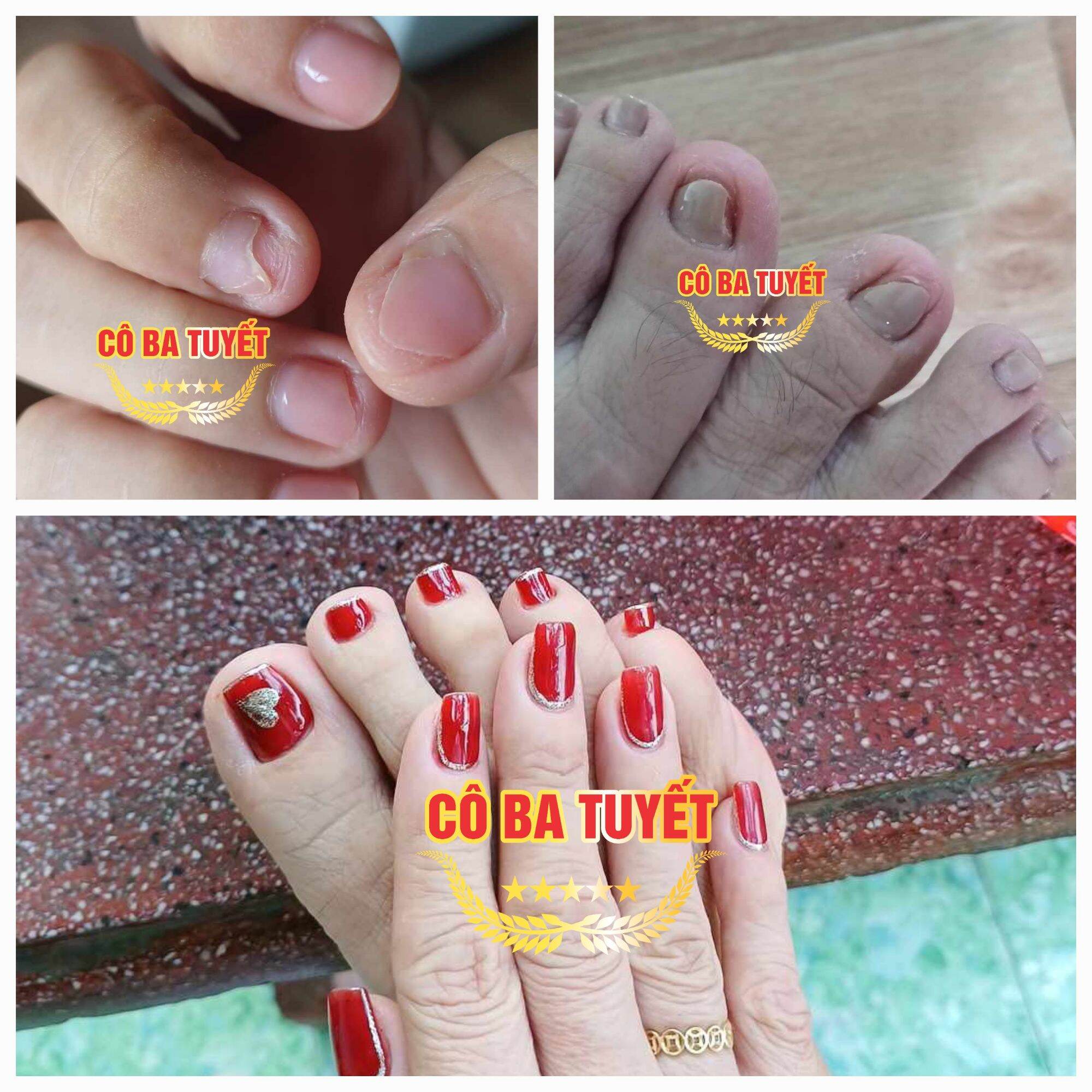 Nấm móng tay chân CO BA TUYẾT