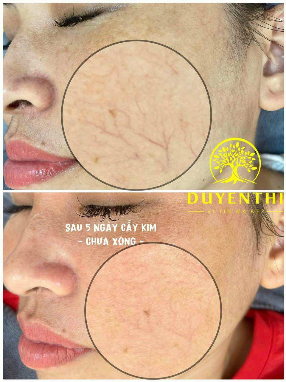 Bộ cấy kim nanotech Duyên Thị- Bách y sâm