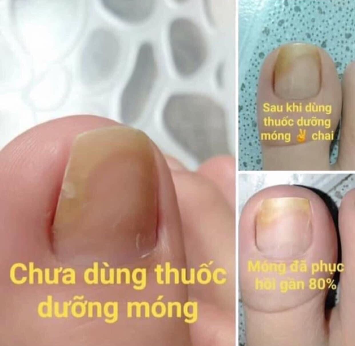 Dung Dịch Nấm Móng
