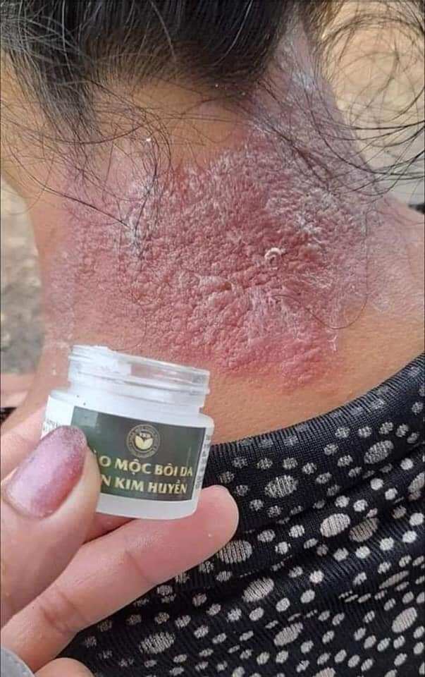 thảo mộc bôi da
