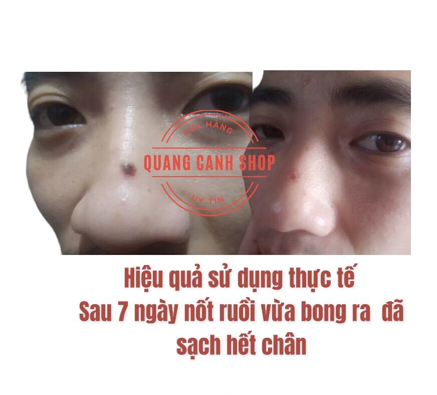 Tẩy nốt ruồi, mụn cóc, mụn cơm, mụn thịt, mắt cá hiệu quả nhanh