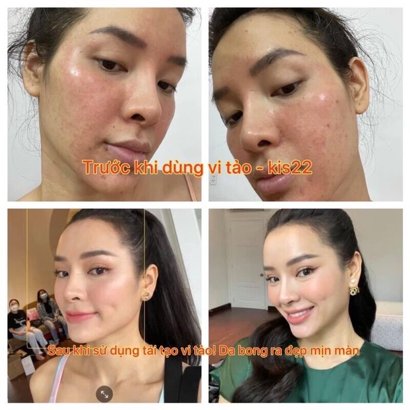Combo tái tạo và phục hồi da  kis22 ( 5 sản phẩm)