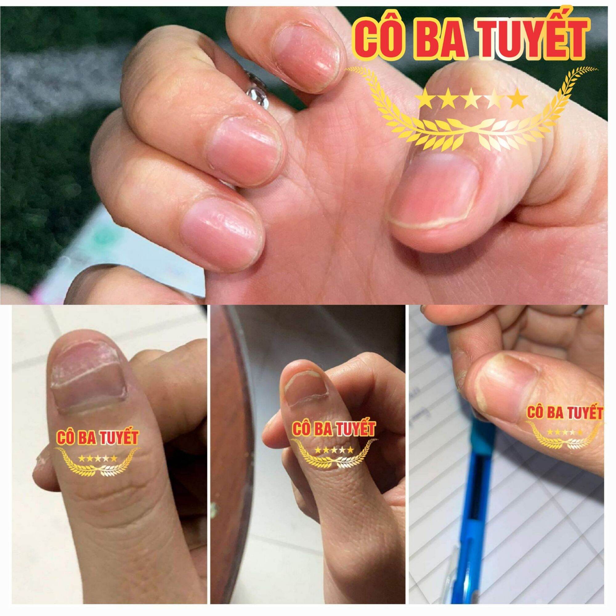 Nấm móng tay chân co ba tuyết