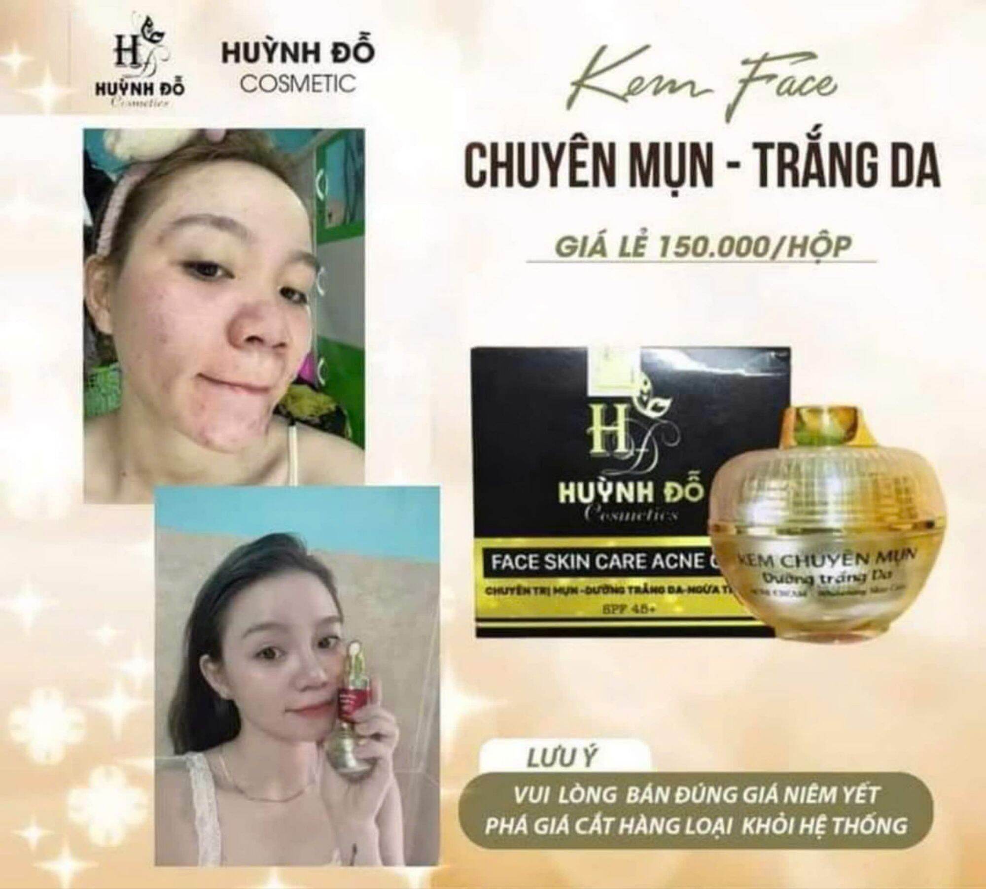 Kem Face Chuyên Mụn và Trắng Da Huỳnh Đỗ