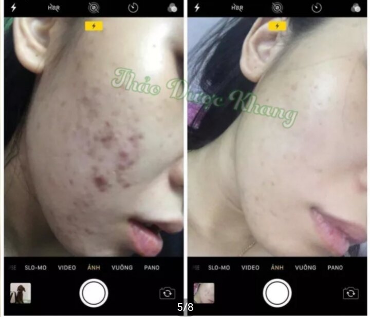 Serum Đánh Bay Sẹo Rỗ Mụn Thâm -Thảo Dược Khang 30ml