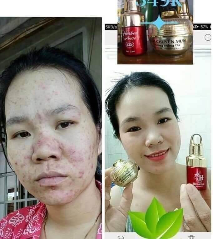 SỈ 2 HỘP FACE MỤN HUỲNH ĐỔ