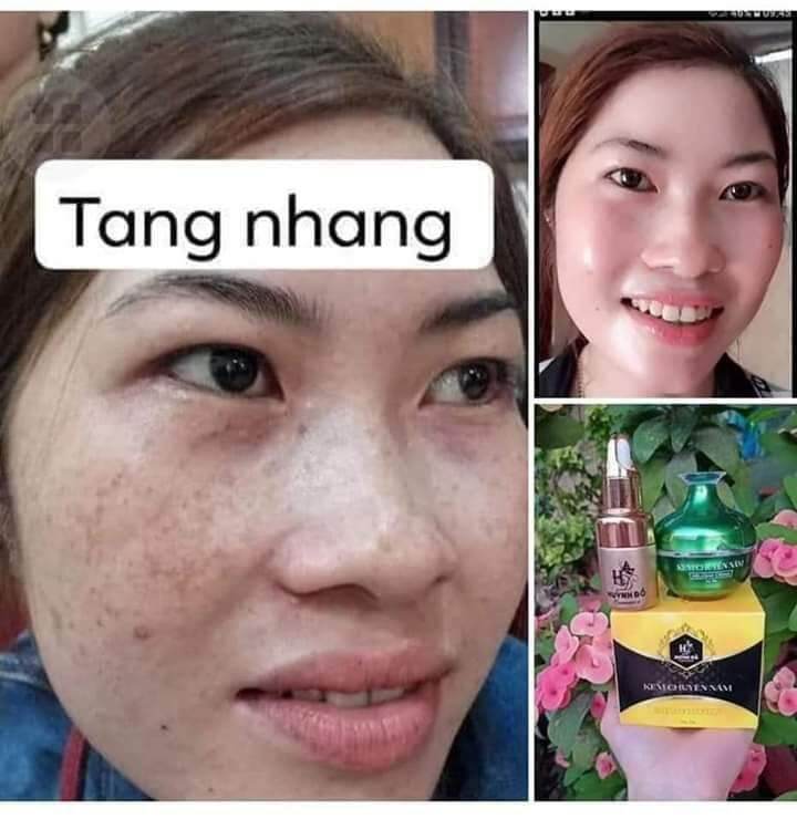 Kem chuyên nám huỳnh đỗ