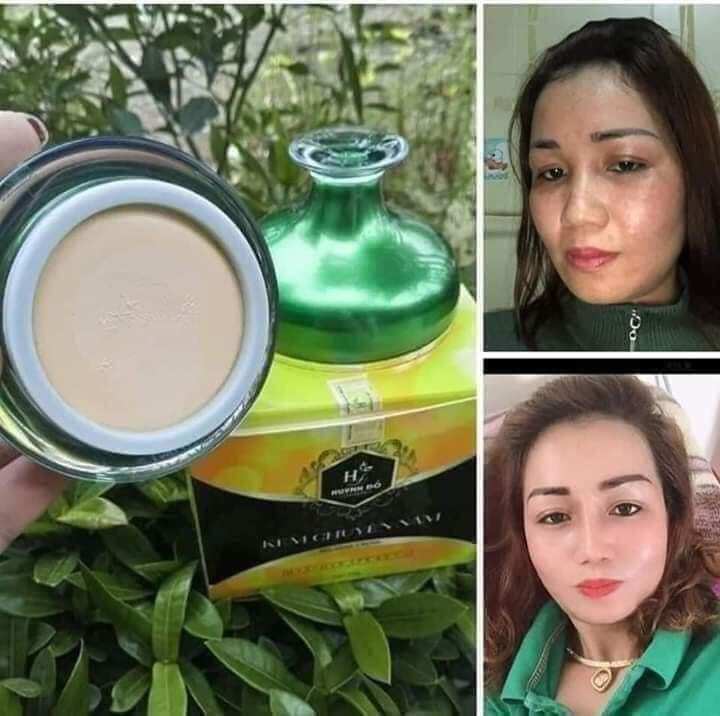 kem chuyên nám Huỳnh Đỗ