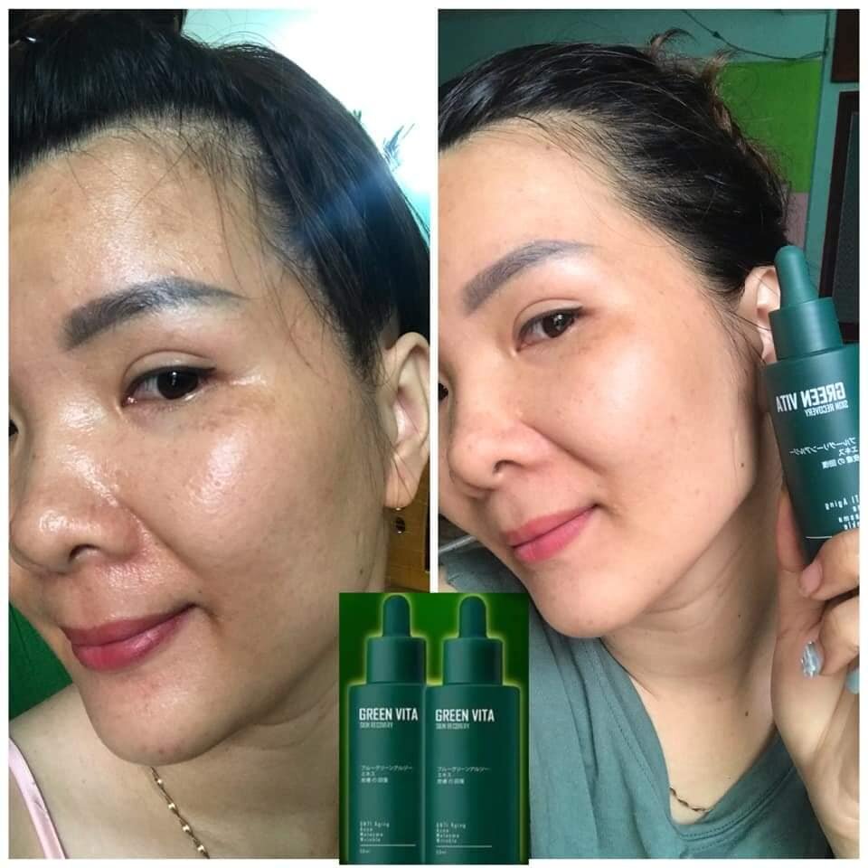 Combo Tái Sinh Da Green Vita (1 Serum và 1 Bột Rửa Mặt)