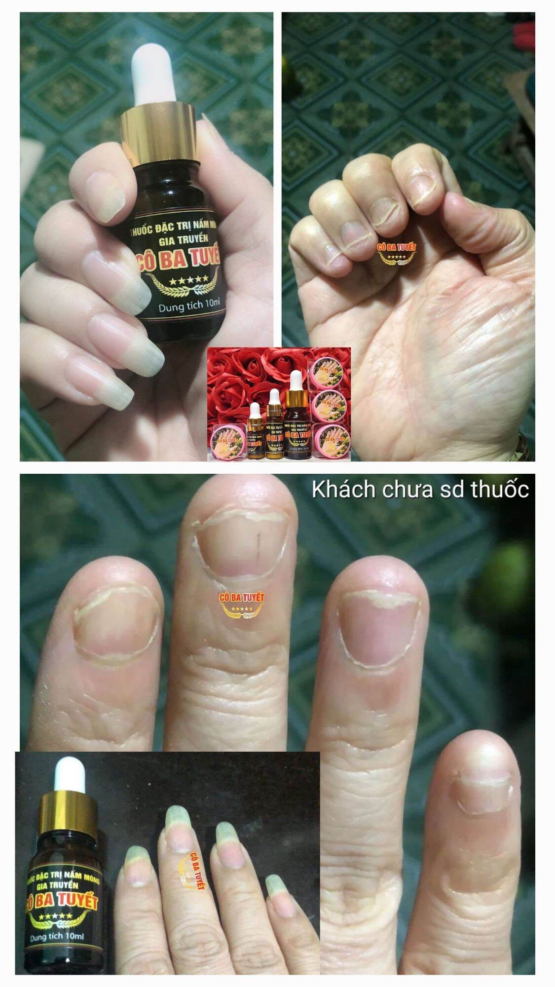 Nấm móng tay chân cô ba tuyết