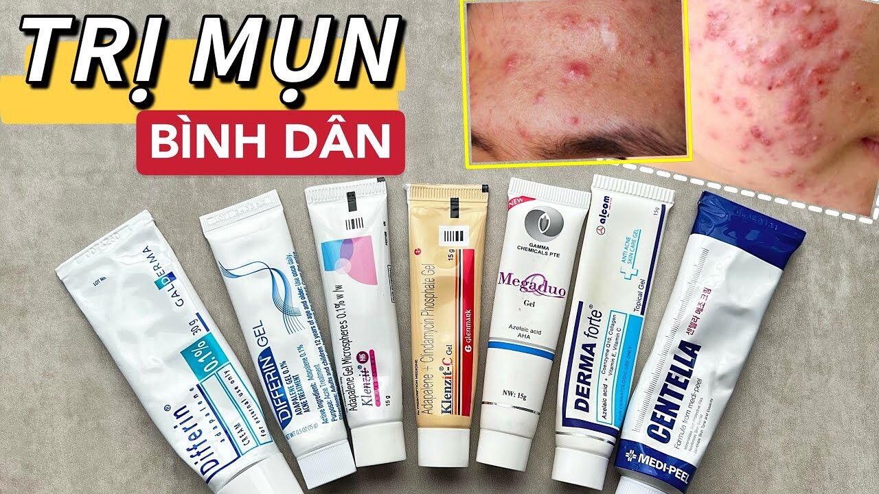 Kem giảm thân mụn ẩn, mụn trứng cá, mụn viêm