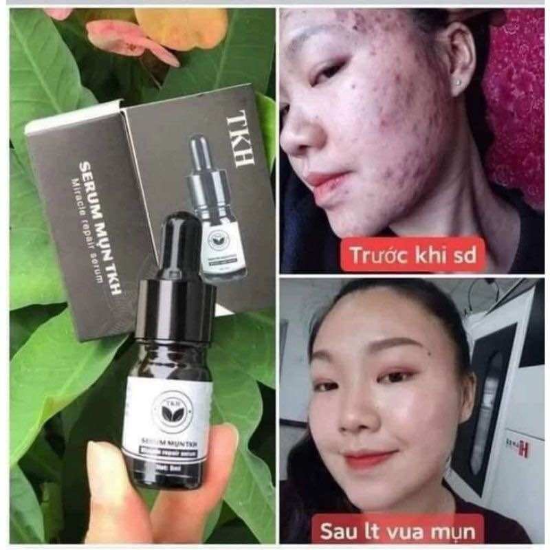 SERUM MỤN TRẦN KIM HUYỀN