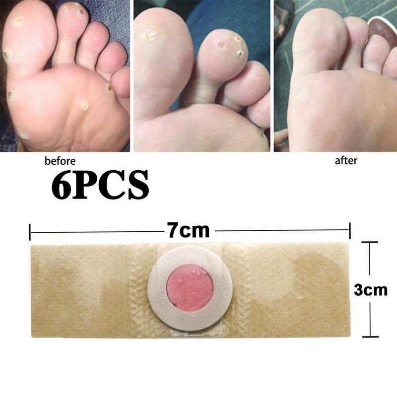 6 Miếng Dán Mụn Cóc, Mụn Cơm