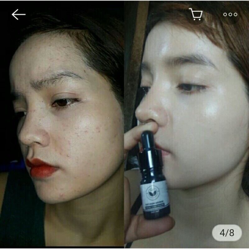 SERUM MỤN TKH