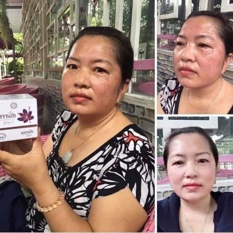 SỈ 5 HỘP KEM NÁM SAFFRON 20gr