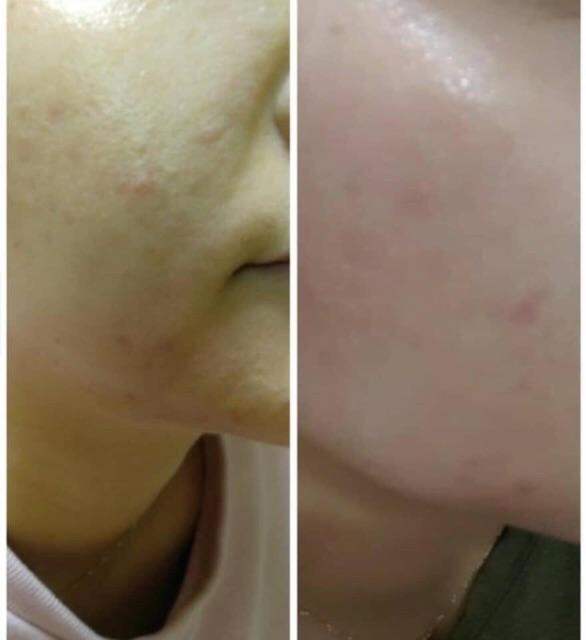 Vi kim tảo biển thay da sinh học CareCella Venus Peel Hàn Quốc (full set)