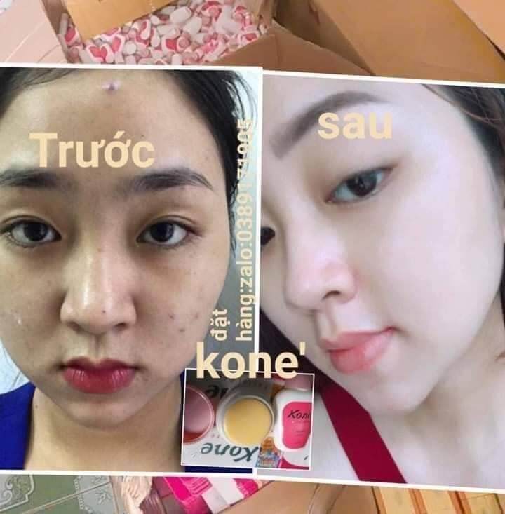NÁM -TRẮNG DA KONE THÁI Mua Sét 3món tặng 1(1hộp kem, sữa rữa mặt,serum nám tặng 1 nạ)