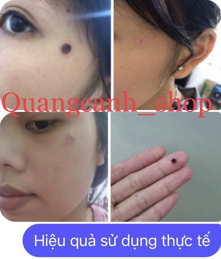 (Loại xịn) Tẩy nốt ruồi, mụn cóc, mụn thịt, mụn cơm,mắt cá( lọ 5ml)