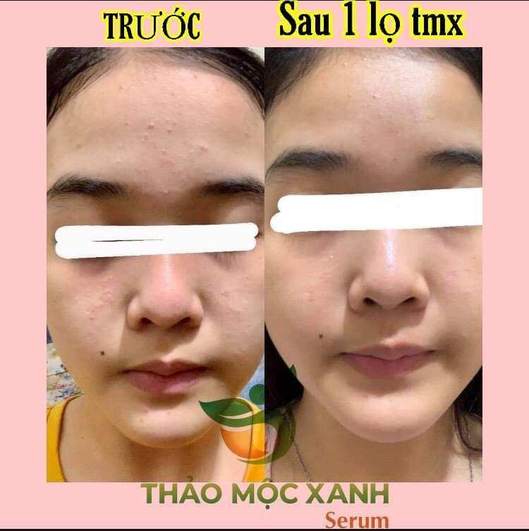 THẢO MỘC XANH SERUM MỤN THAY ĐỔI RÕ RỆT SAU 5 NGÀY SỬ DỤNG