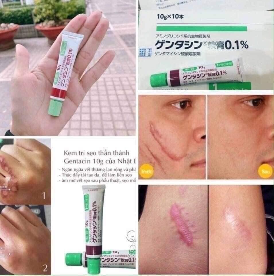 Kem sẹo gentacin nhật bản sẹo lồi sẹo lõm sẹo thâm