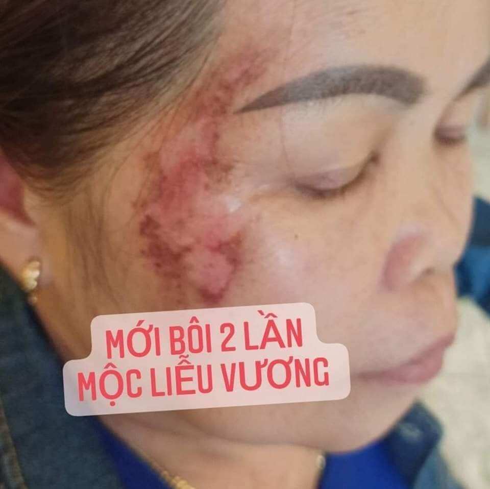 [Mẫu mới] kem bôi da mộc liễu vương lan chi 20gr