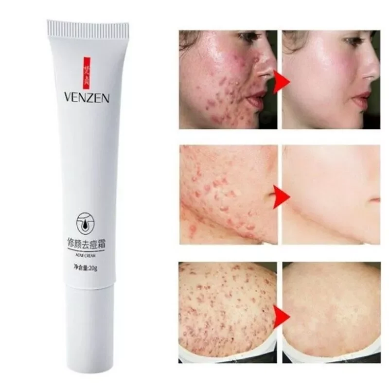 Tuýp kem giảm mụn của bioaqua