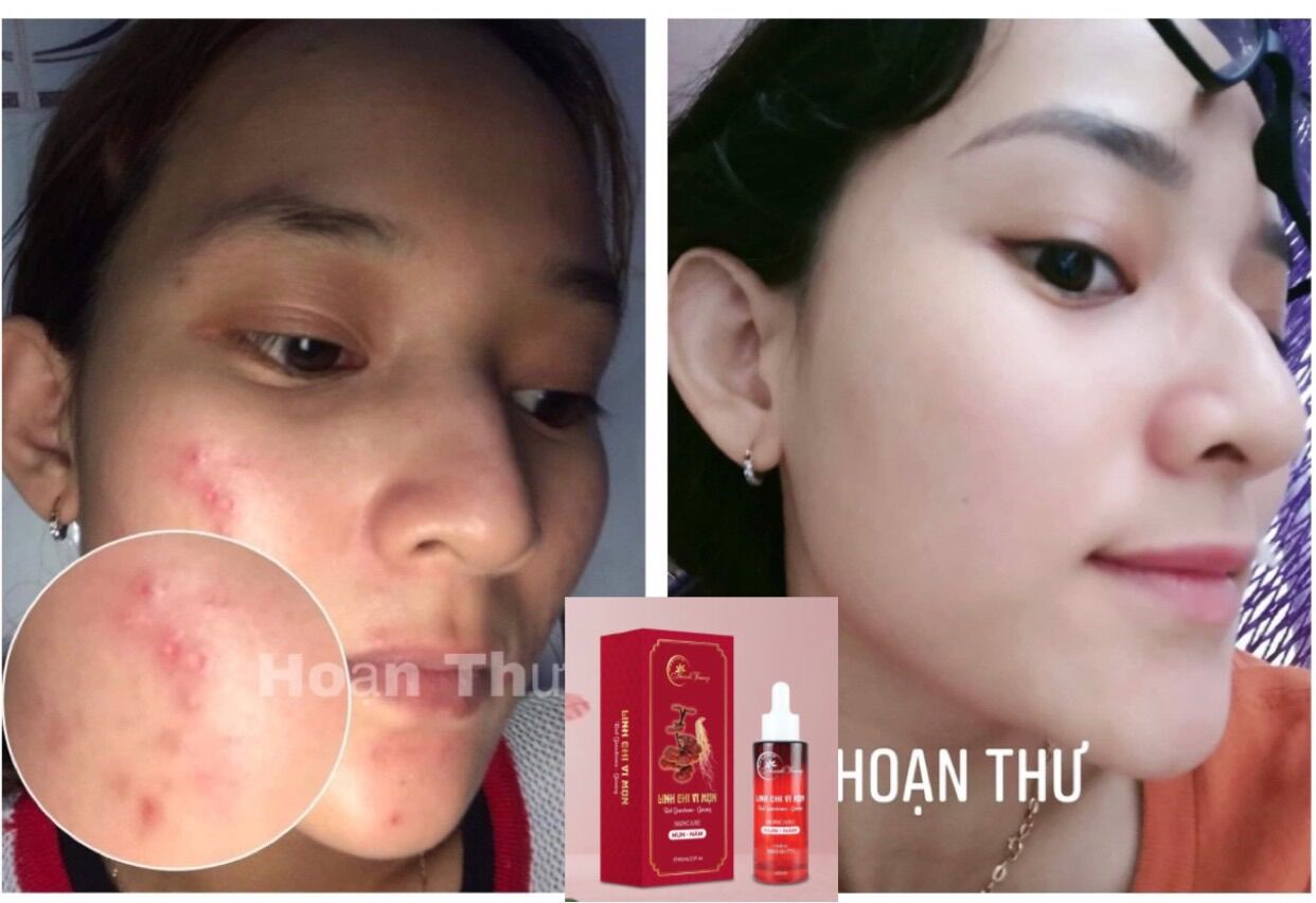 Combo Thảo dược hết mụn, thâm nám Thanh Trang