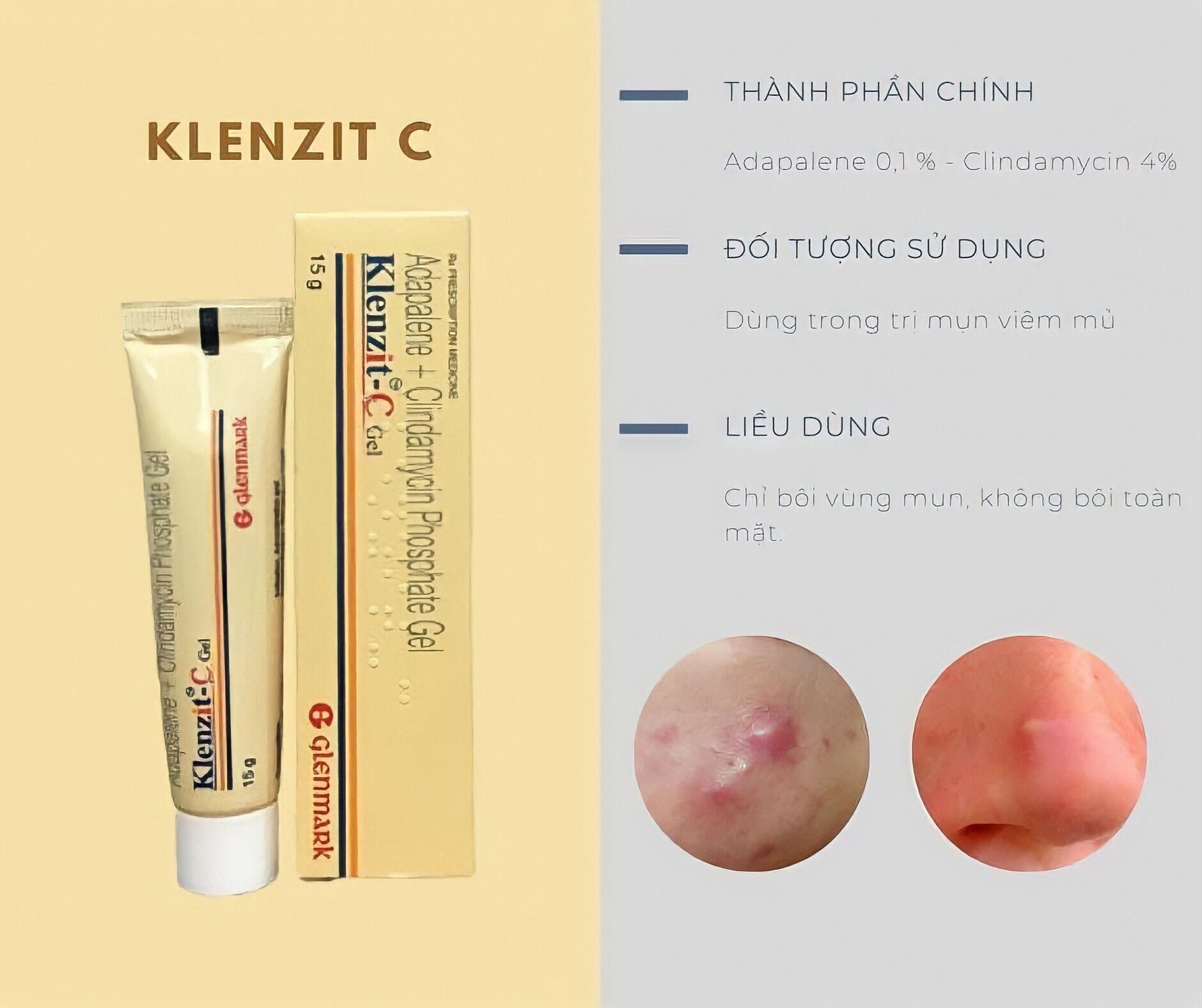 Kem trị mụn mủ, mụn bọc, mụn sưng đỏ to