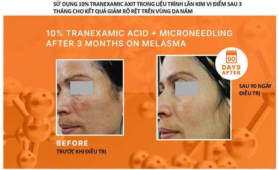 [Hàng Cty-Tách lẻ 1 ống 2ml]Tinh ChấtDưỡng Trắng Sáng Da TRANACIX