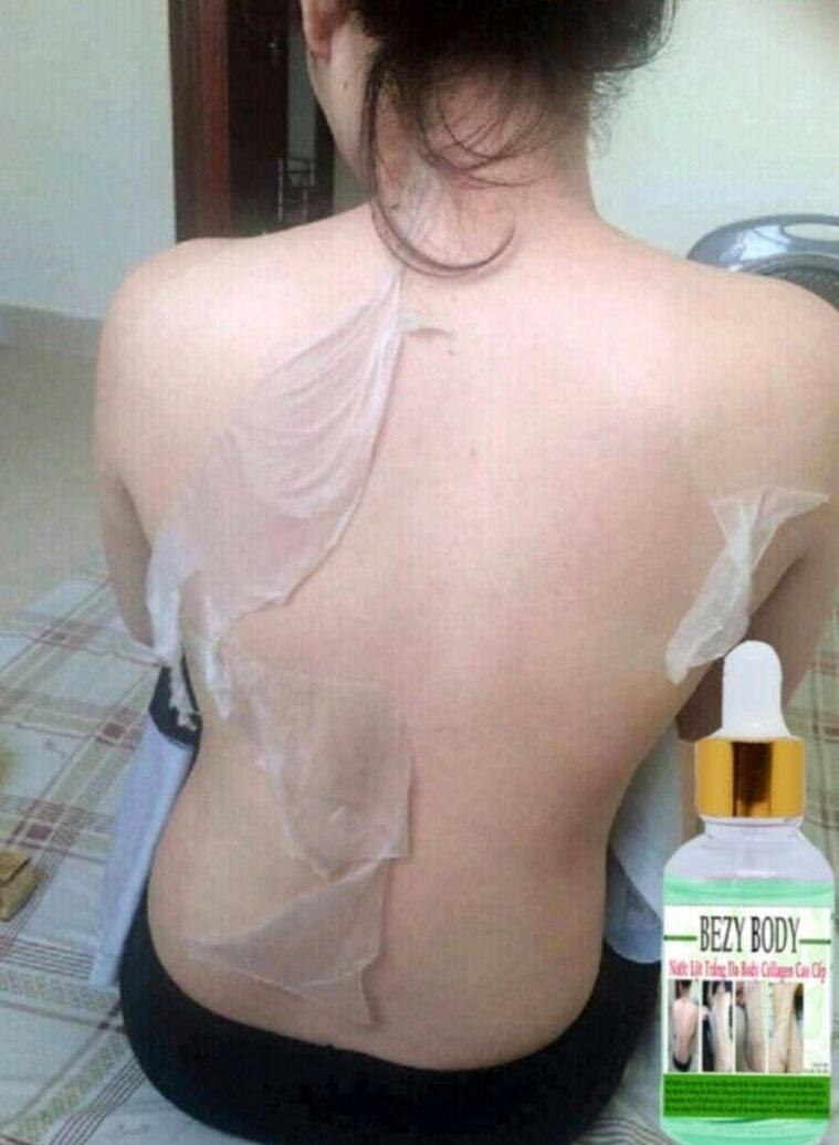 NƯỚC LỘT BEZY BODY thay da sinh học