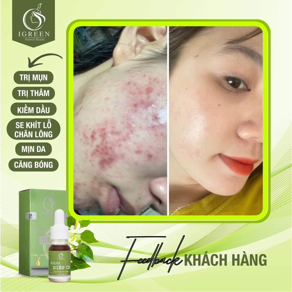 SERUM DIẾP CÁ GIẢM MỤN, THÂM, SE KHÍT LỖ CHÂN LÔNG - IGREEN