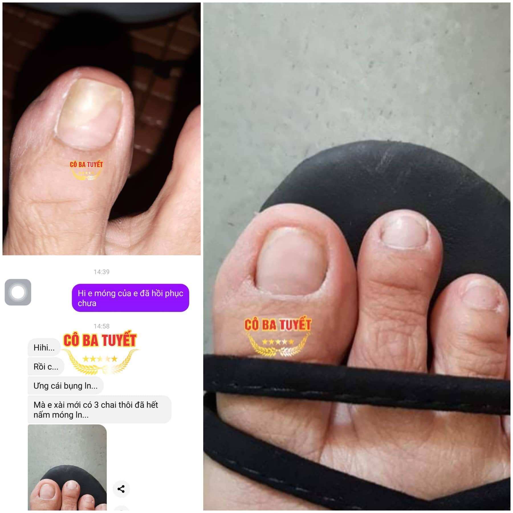 Nâm Móng Tay Chân , Dưỡng Móng