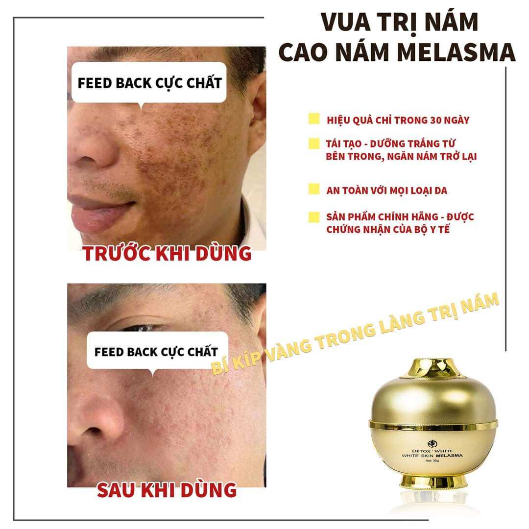 CAO NÁM MELASMA
