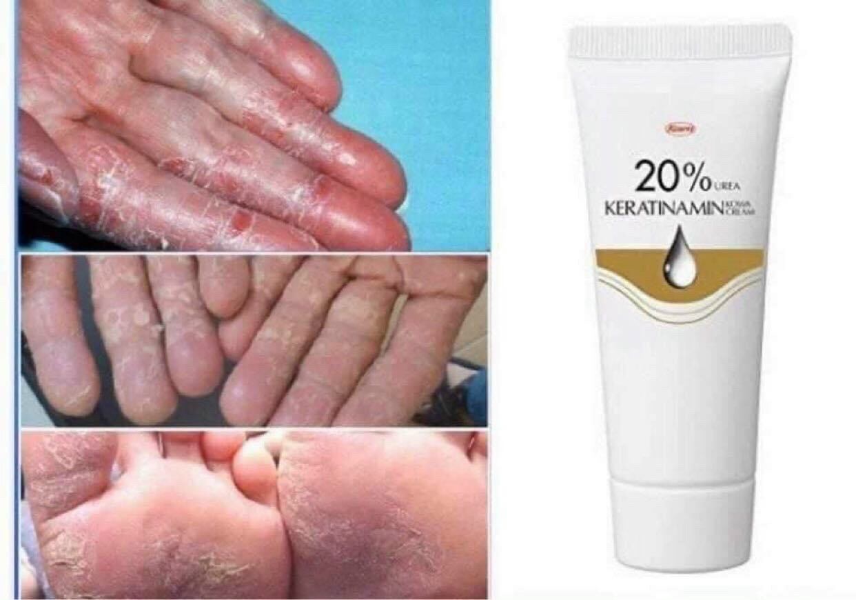 Kem bôi nứt nẻ tay chân á sừng
