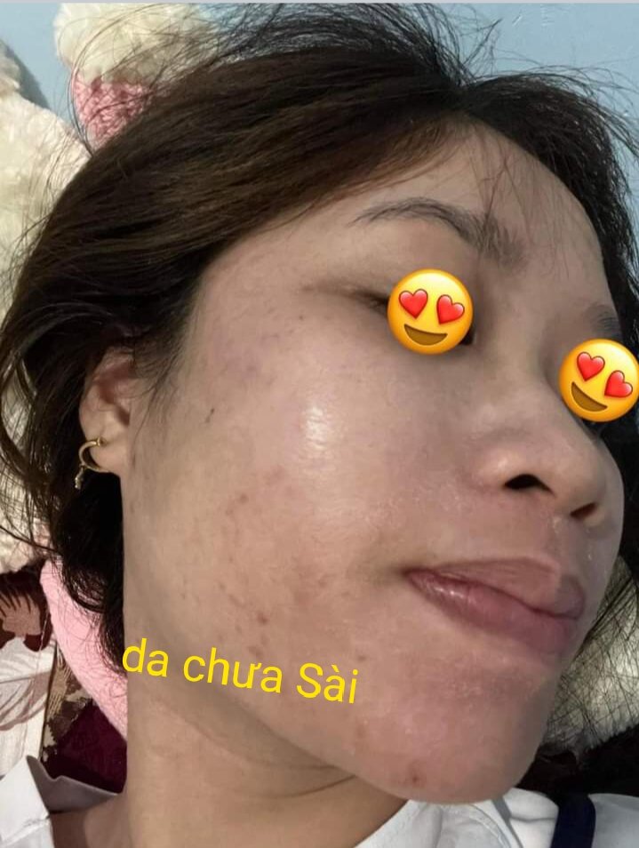 Bộ kem t&t đánh bay nám, mụn ,da đen sạm ,đạc kết quả lên đến 99%