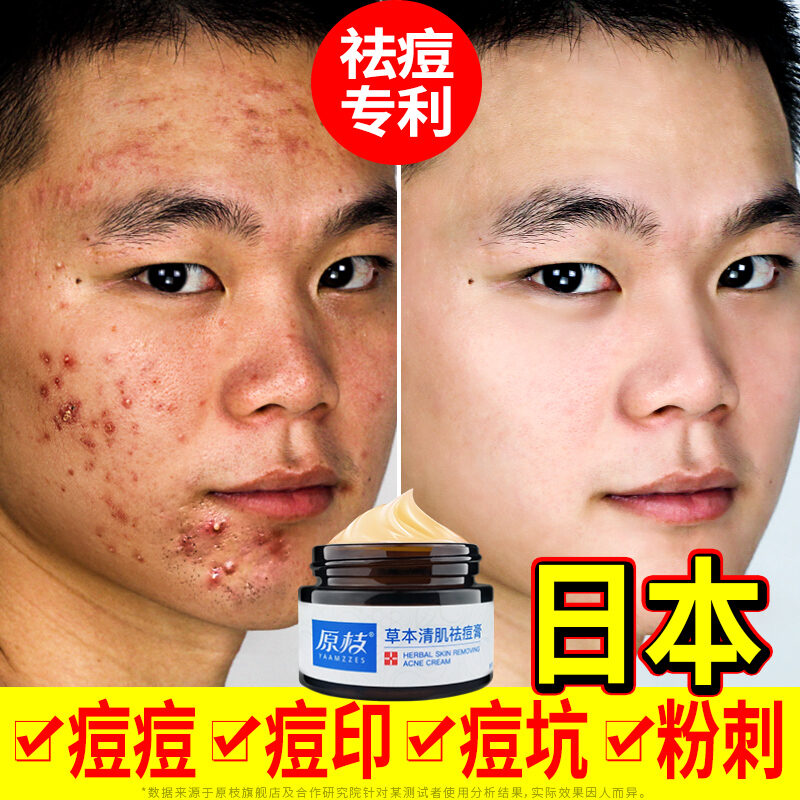 Nhật Bản Trị Mụn Loại Bỏ Vết Sẹo Mụn Pox Mụn Trứng Cá Phai Nữ Nam Chống Mụn Trứng Cá Chính Hãng Không Đóng Cửa Mụn Sửa Chữa Máy Thần Kỳ